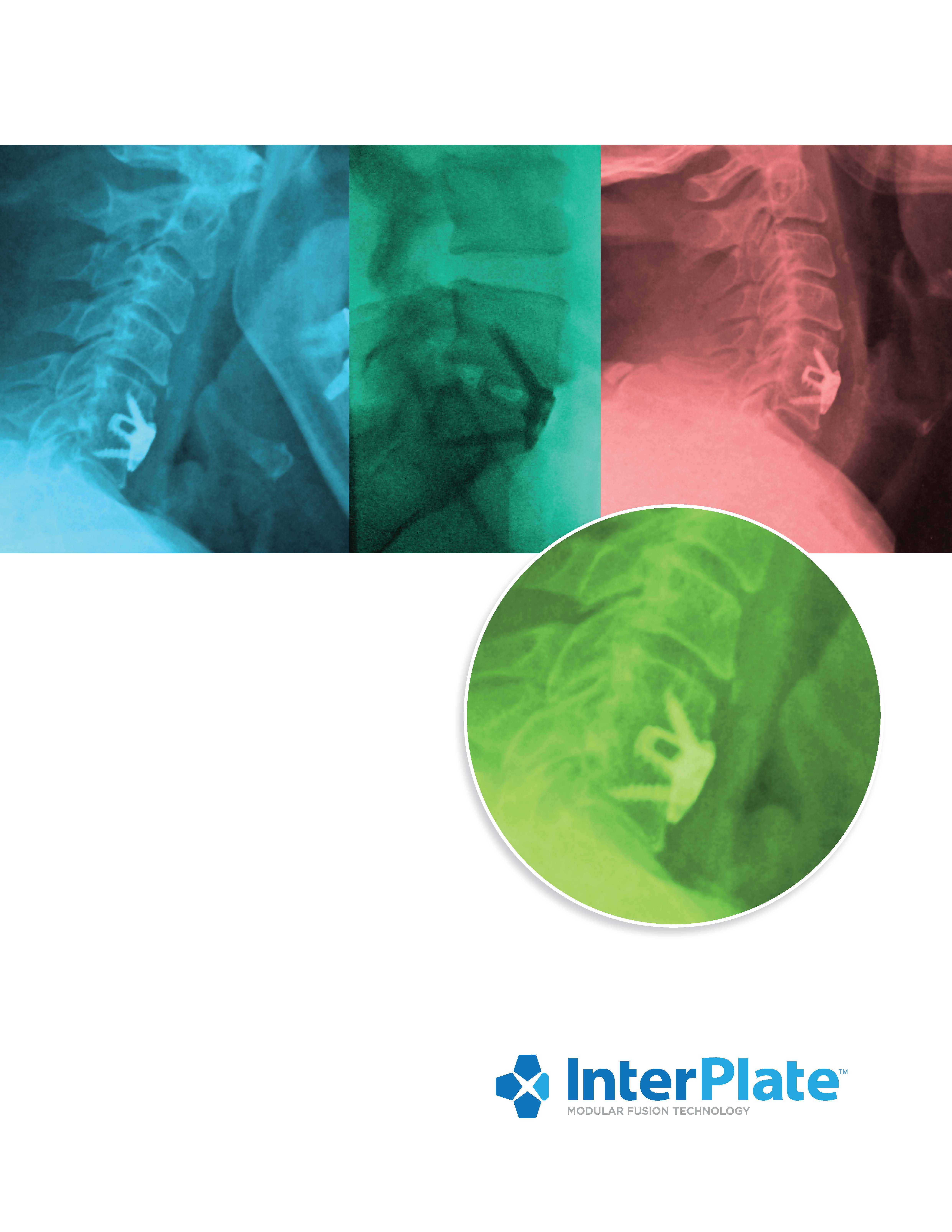 Percutaneous Instruments for Bone Graft Harvesting